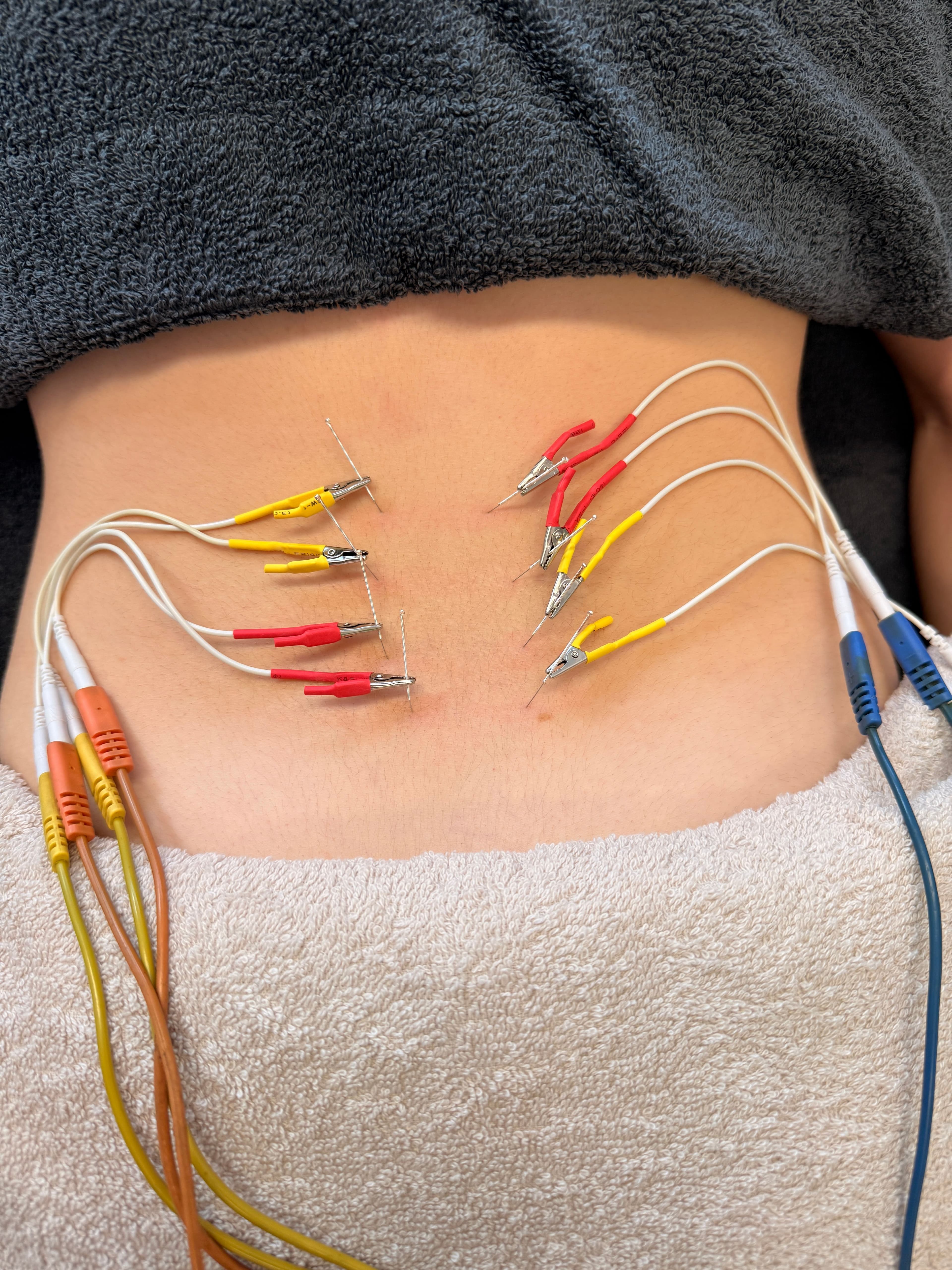 Dry Needling Behandlung bei muskulären Beschwerden in der Theraist Physiotherapie Bludenz